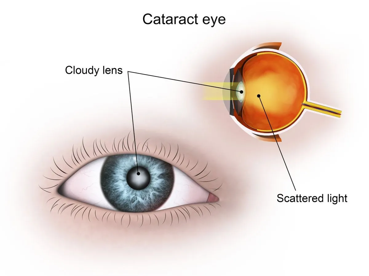 Phacoemulsification cataract surgery being performed at Max Hospital, South Delhi